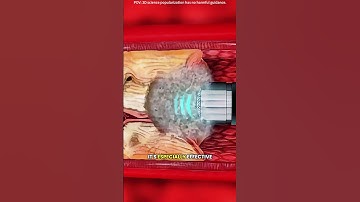 How rotational atherectomy is performed?(3D animation) #drone #theflash #space #automobile #scifi