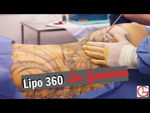 lipo-360|-liposuction|-before-and-after|-dr.-gartner