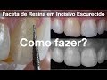 Faceta de Resina Composta em Incisivo Central Escurecido