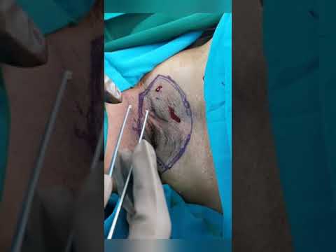 التهاب الغدد العرقية التهاب الغدد العرقية القيحي دكتور محمد يونس