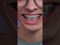 how to brush braces