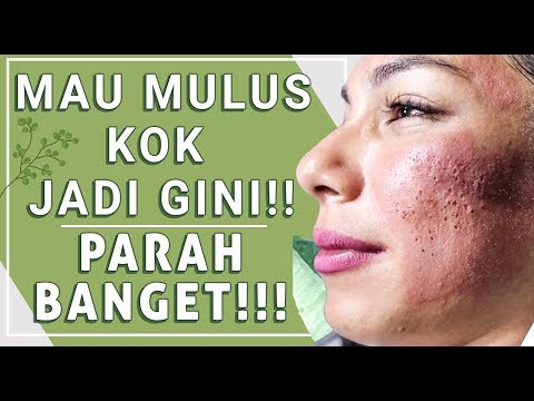 Menghilangkan Muka Bopeng Bekas Jerawat & Pori besar || Acne Scars Treatment || Fractional laser