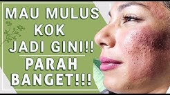 Menghilangkan Muka Bopeng Bekas Jerawat & Pori besar || Acne Scars Treatment || Fractional laser - Durasi: 8.37. 