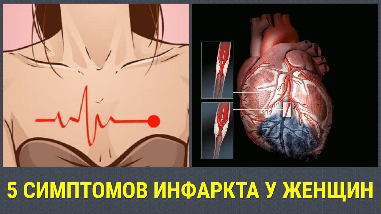 ПРЕДИНФАРКТНОЕ СОСТОЯНИЕ У ЖЕНЩИН. КАК РАСПОЗНАТЬ ИНФАРКТ У ЖЕНЩИН ...