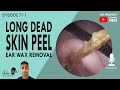 711 - Long Dead Skin Peel Ear Wax Removal