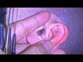 effective ear wax removal #34