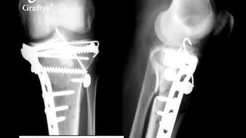 Graftys plateau tibial 3D video V1 youtube