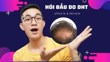 TTL | UPDATE & REVIEW Trị hói đầu do DHT và sản phẩm DHT BLOCKER FIT