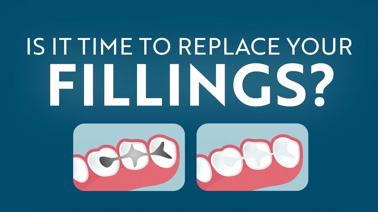 Is it Time to Replace Your Silver Fillings?