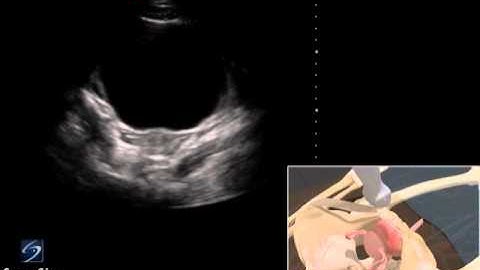 How To: EFAST - Pelvis 3D Video