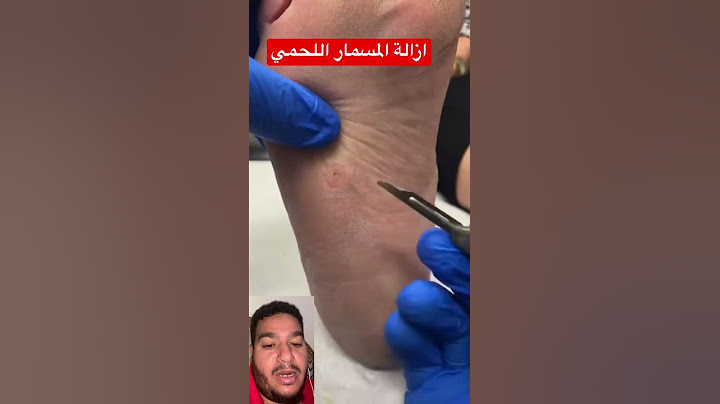 نصائح للوقايه من الإصابة بمسمار القدم الحمي