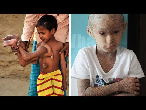 Video: Een Kind Met Een Uiterlijk Hart Werd Geboren In India - Alternatieve Mening