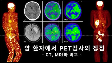 암 환자에서 PET검사의 장점 (CT, MRI와 비교)