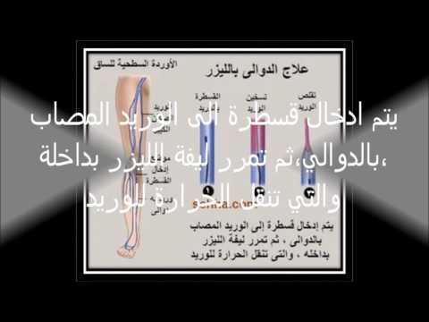 علاج الدوالى بمستشفى مركز مكة الطبي