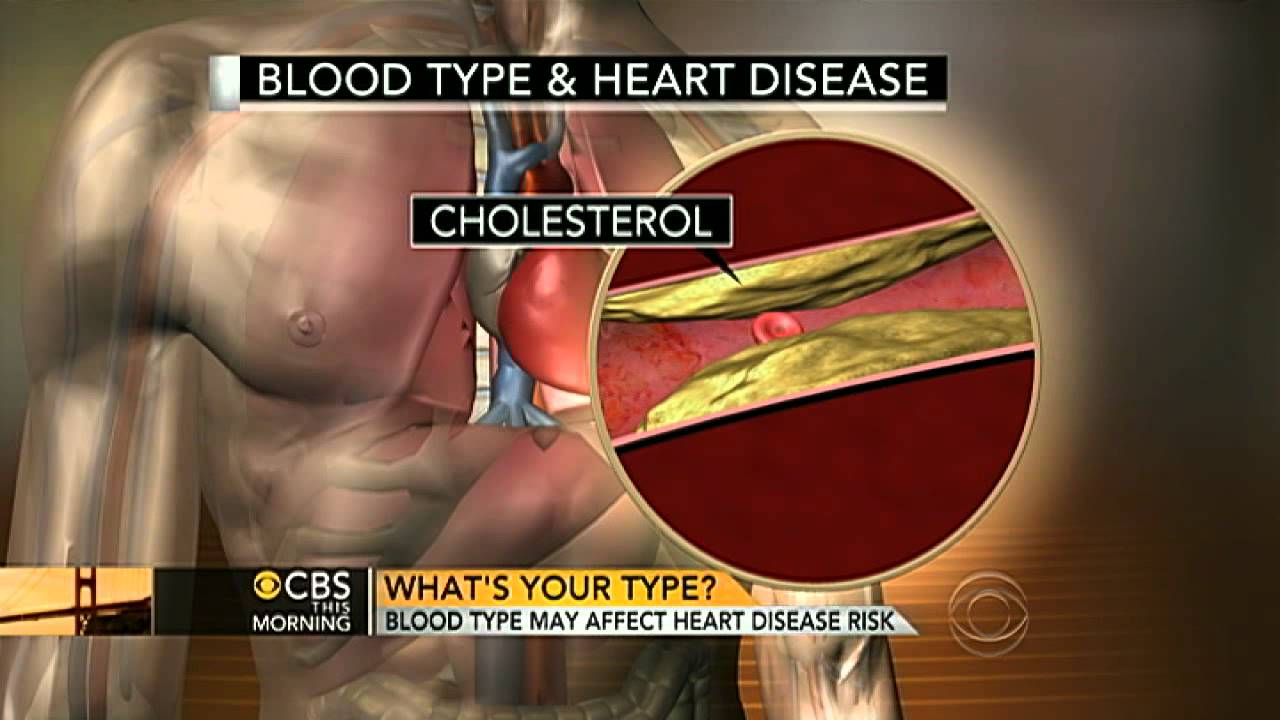 Blood group may affect heart attack risk