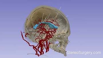 Interactive Stereotactic Phantom / Update #1 / StereoEEG training
