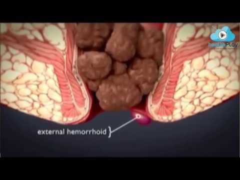 Hemoroid (Basur) Çeşitleri Nelerdir? Op.Dr.Kadir Uskuay