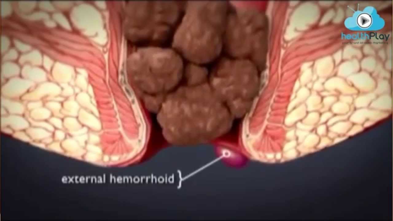 Hemoroid (Basur) Çeşitleri Nelerdir? Op.Dr.Kadir Uskuay - YouTube