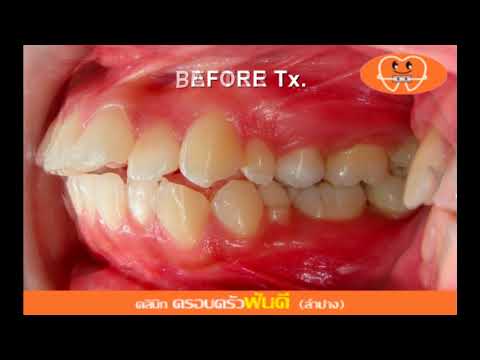 ฟันซ้อนเก (Dental crowding) C.20871