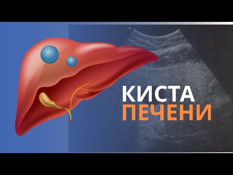 Киста печени простая и другие кистозные образования. УЗИ картина и алгоримтм диагностики.