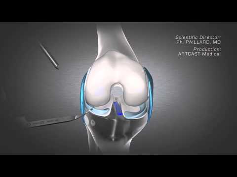 Video: Cum se repară leziunile ligamentului genunchiului