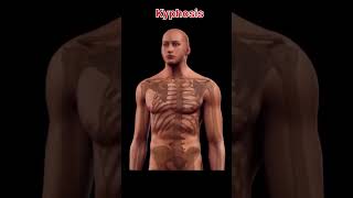 Kyphosis outward curvature🦴 #orthopedics #facts #ytshorts #spine #kyphosis #discbulge #curvedspine