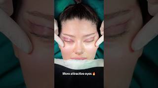 Endoskopic Midfacelifting And Upper Blepharoplasty Combination Surgery 👏👏👏