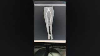 “3D Lower Limb Angiography on Canon 640-Slice CT (Vitra Workstation)”