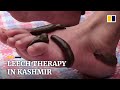 Kashmir residents seek leech therapy on Navroz