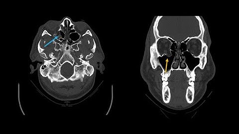Describing the typical appearance of skull fractures as seen on computed tomography (CT) imaging
