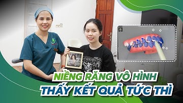 Tất cả những điều cần biết trước khi bắt đầu đeo khay niềng răng trong suốt Invisalign