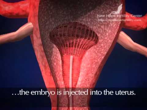 Embryo Transfer