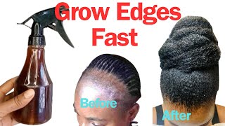Use This Hair Growth Treatment To Grow Back Your Edges. Do not Doubt It, Works 100%