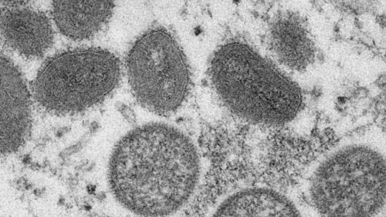 Columbus Public Health investigating local case of monkeypox