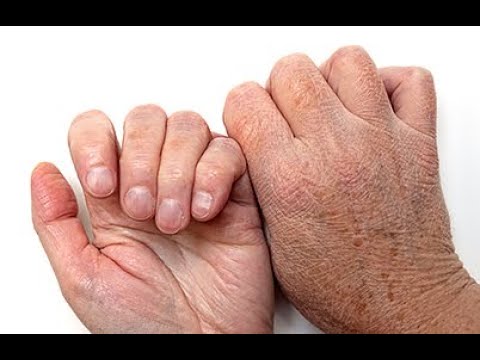 Video: Kuru Çatlamış Elleri İyileştirmenin 3 Yolu