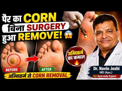 पैर का Corn बिना Surgery हुआ Remove! 😱 | अग्निकर्म से Corn Removal | Ayurveda Treatment