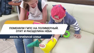 СЕРЁЖЕ ПОМЕНЯЛИ ГИПС НА ПОЛИМЕРНЫЙ | ОТИТ И РАСЩЕЛИНА НЁБА