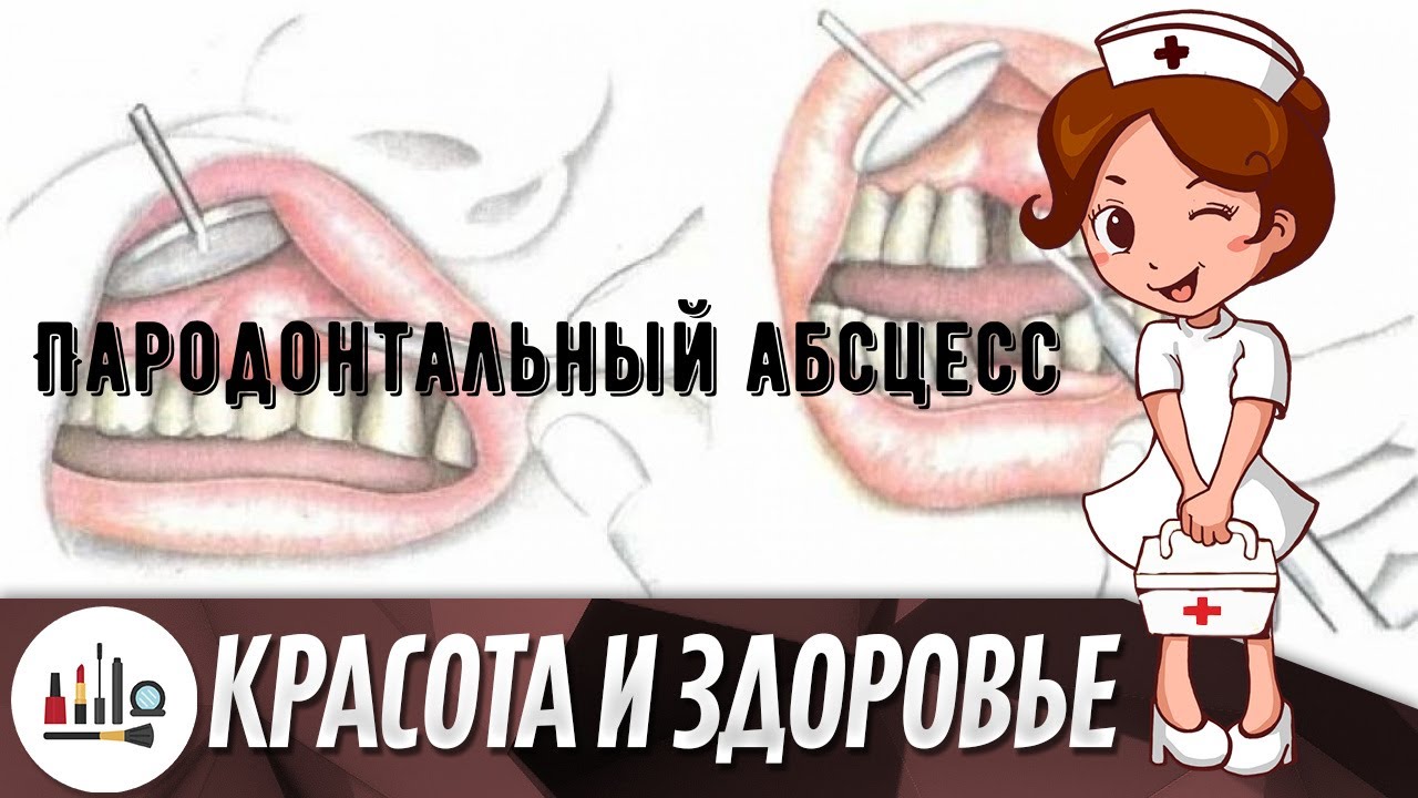 Пародонтальный абсцесс