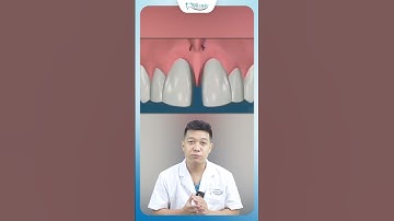 Xử Lý Khe Thưa Ở Răng Cửa Mà Không Cần Niềng Răng | Nha Khoa Minh Châu