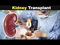 How Does Kidney Transplant Works? | Kidney Transplantation Explained (Urdu/Hindi)