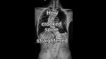 How a crooked back is straightened ! SCOLIOSIS SURGERY.       #SCOLIOSIS #SCOLIOSISAWARENESS