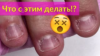 Преображение Обгрызенных Ногтей - Наращивание Акрилом Преображение Обгрызенных Ногтей - Наращивание Акрилом