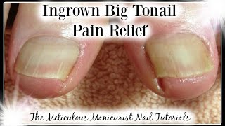 How to Remove an Ingrown Big Toenail for Pain Relief ♥ Pedicure ♥