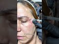 Tratamiento Botox #botox #botoxfillers #botoxinjections