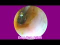 ASMR Ear Cleaning | Guaranteed Tingles and Instant Relaxation