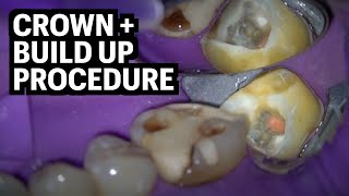 Build Up + Crown Procedure {Tooth Cavity Removed w/ Rubberdam) by Smile Influencers 18,894 views 1 year ago 3 minutes, 14 seconds