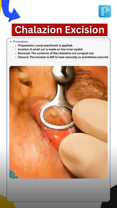 All about Chalazion Excision!