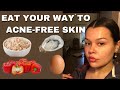 HOW TO GET RID OF ACNE NATURALLY | Food-related acne PT. 2