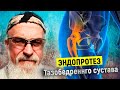 КОКСАРТРОЗ и ЭНДОПРОТЕЗ. Эндопротезирование сустава | ТРЕНЕР ХАПАЕВ