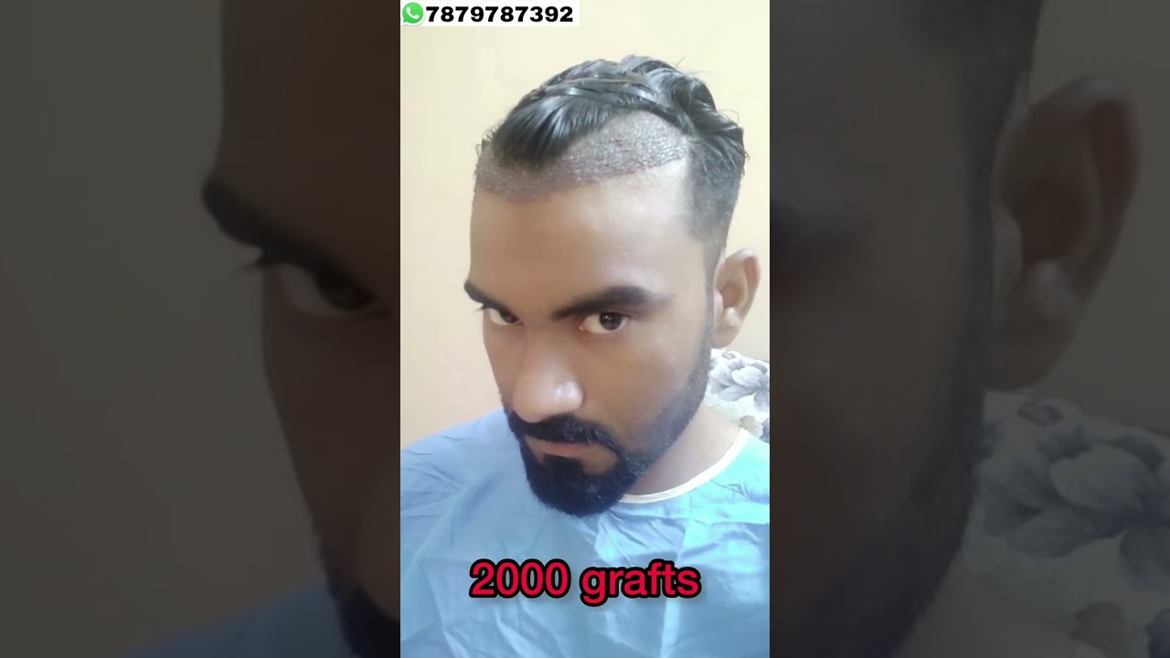 My hair transplant 2 years condition 😊😊 